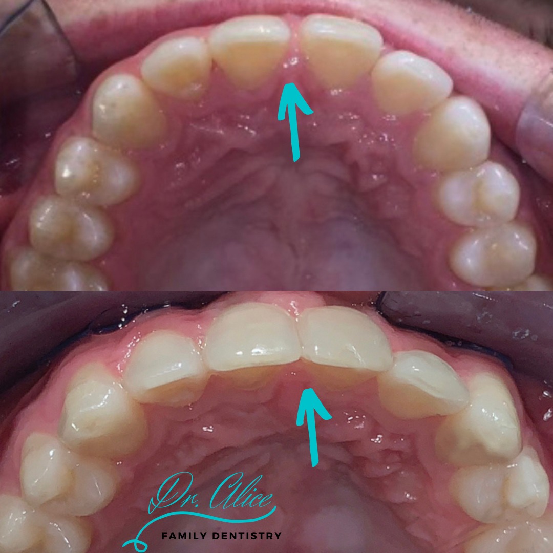 Implants | Dental Implants by Dr. Alice Family Dentistry