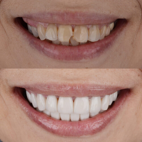 Complete,Smile,Makeover,From,Darken,Teeth,And,Crooked,Teeth,To